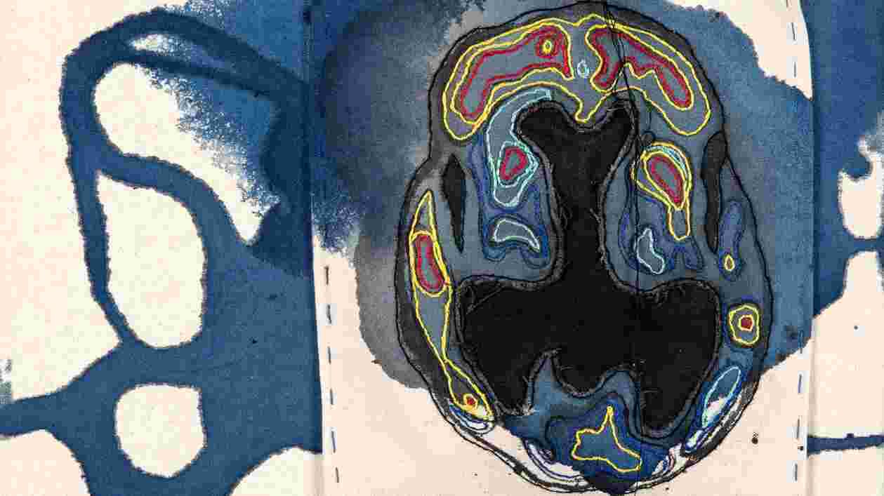 Dementia stain 1920x1080 Thumbnail