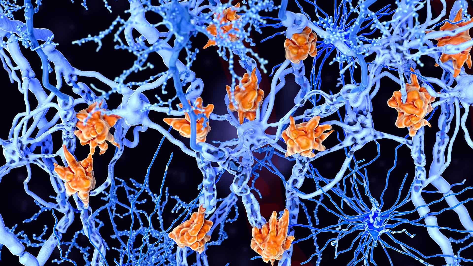 microglia cells (orange) damage the myelin sheath of neuron axons